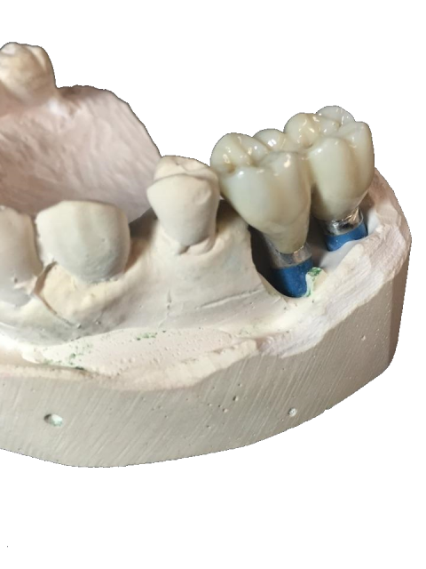 full contour zirconia on 2 implants abuttments